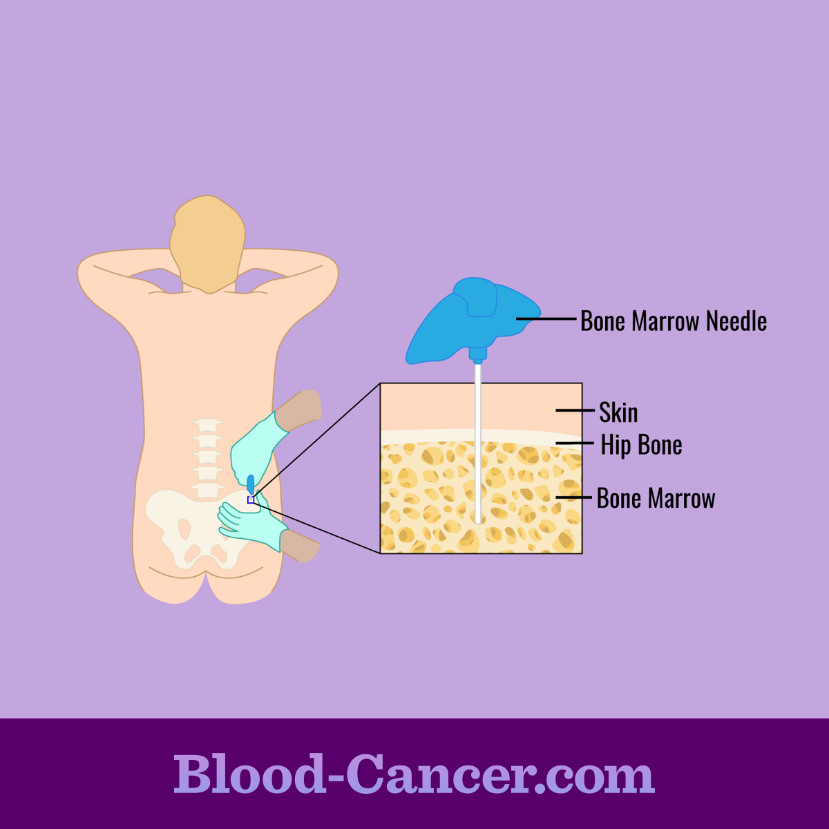 Bone marrow needle inserted through the skin and hip and into the bone marrow of a person lying face down