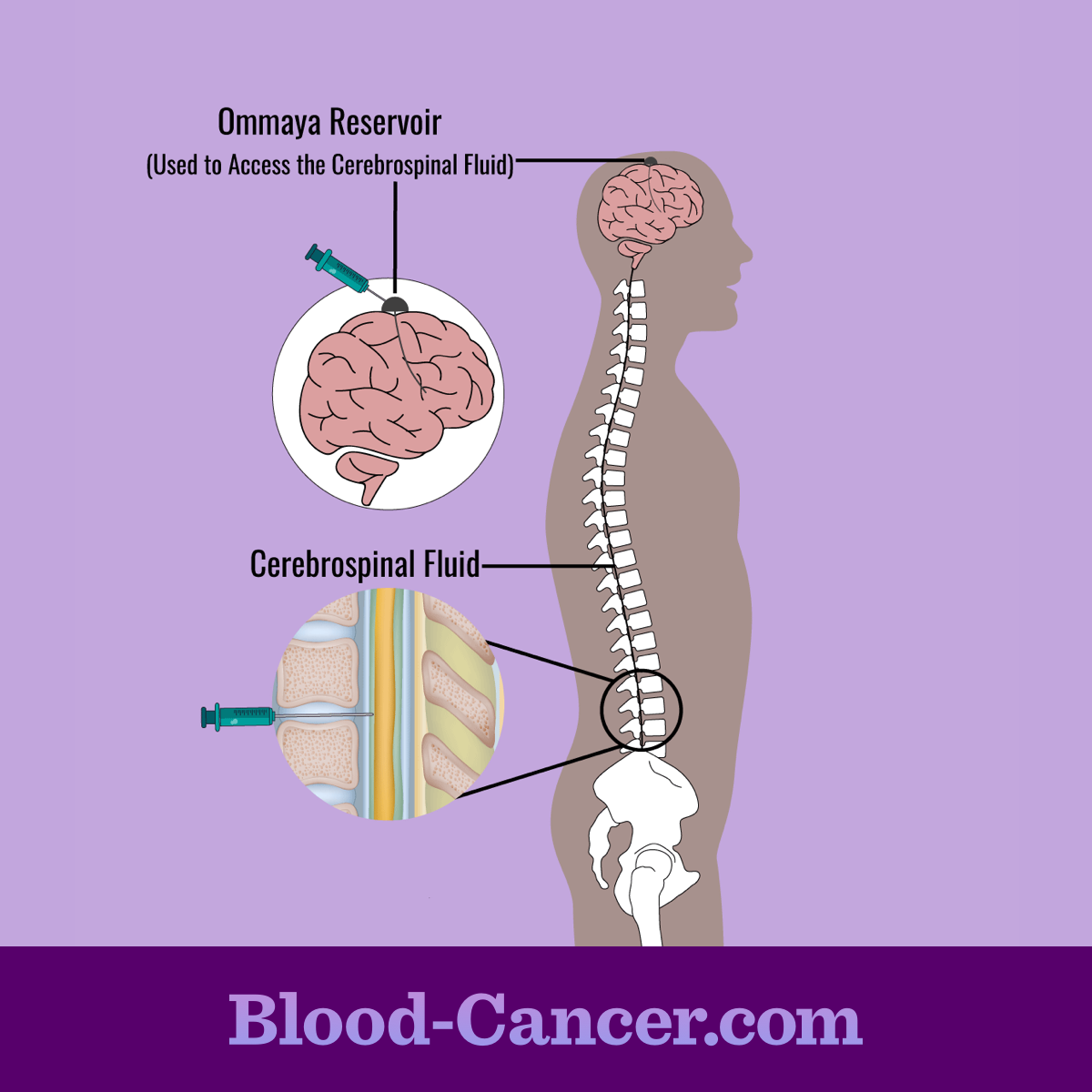 leukemia treatment chemotherapy