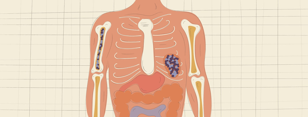 An overlay of a person's torso, showing cancer in a bone and an organ