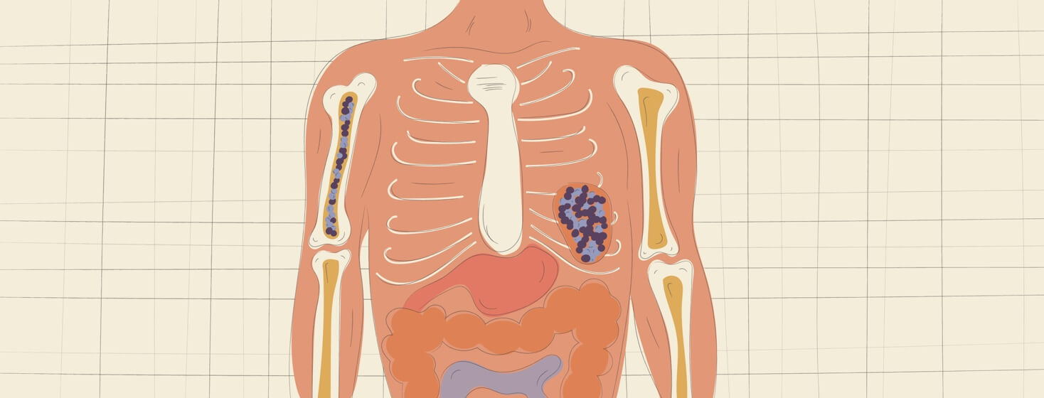 What is CLL/SLL?