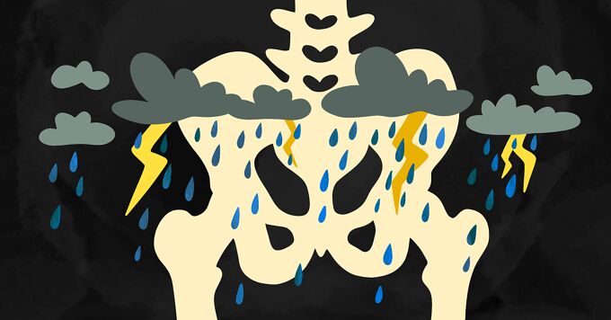 Bone Damage and Lytic Lesions With Multiple Myeloma image