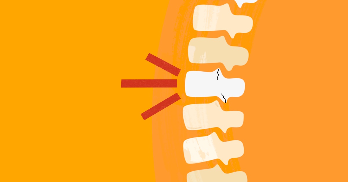 The Damage to My Bones I Didn't See Coming With Myeloma image